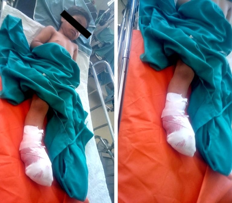 Niño “Yefri” es intervenido quirúrgicamente por segunda vez