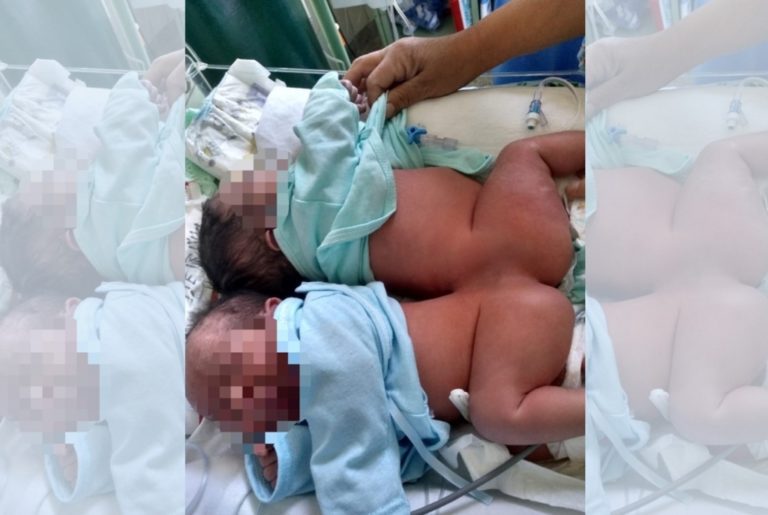 Arequipa: Bebés siameses serán operados en Hospital Goyeneche