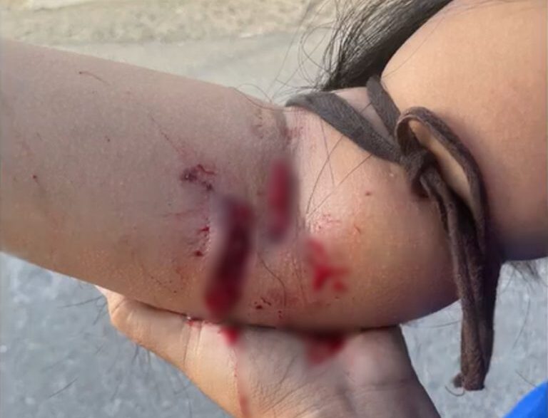 Ataque de perro deja grave a joven mujer en Mollendo