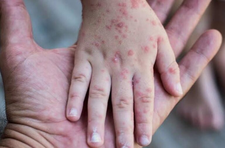 Incluye región Arequipa: declaran emergencia sanitaria por sarampión